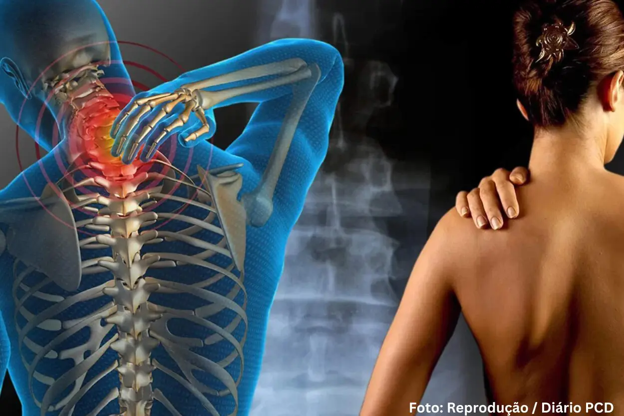 Mariana reconhece pessoas com fibromialgia como pessoas com deficiência